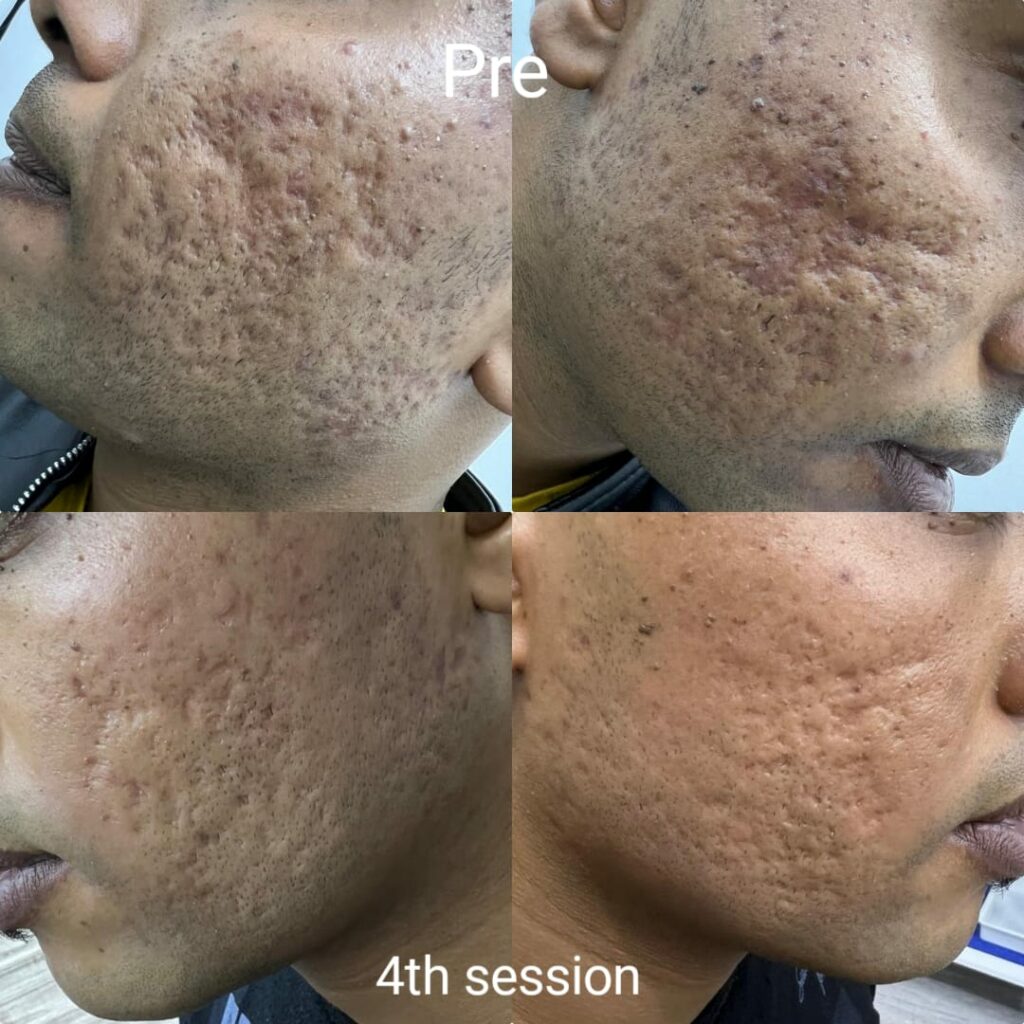 Treatment of large pores before and after